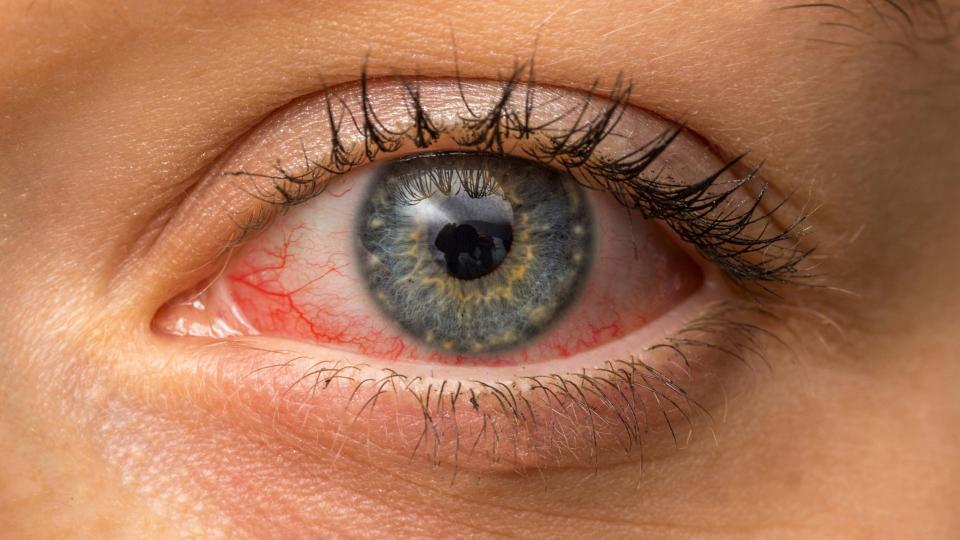 Επιπεφυκίτιδα : Η πάθηση των ματιών 
