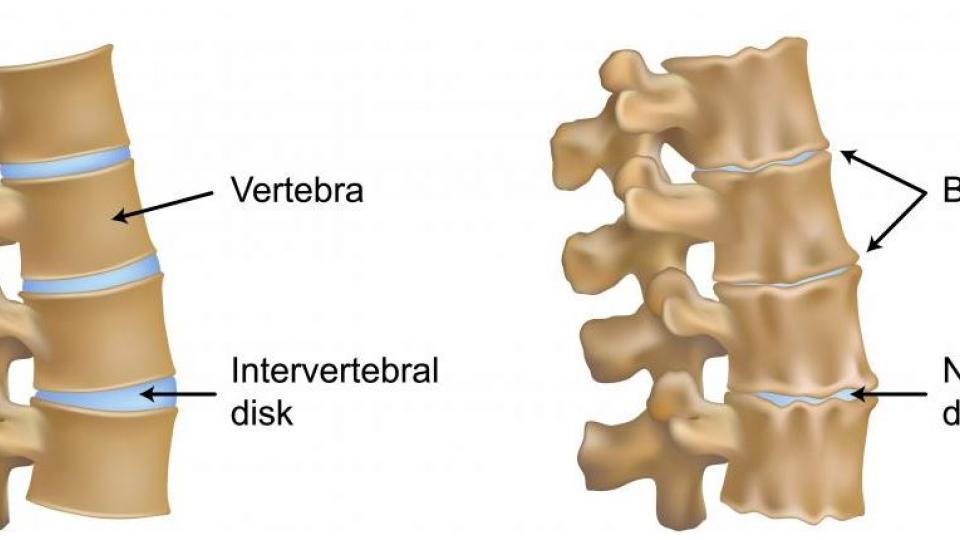 Οστεόφυτα : Η πάθηση της σπονδυλικής στήλης και των άκρων