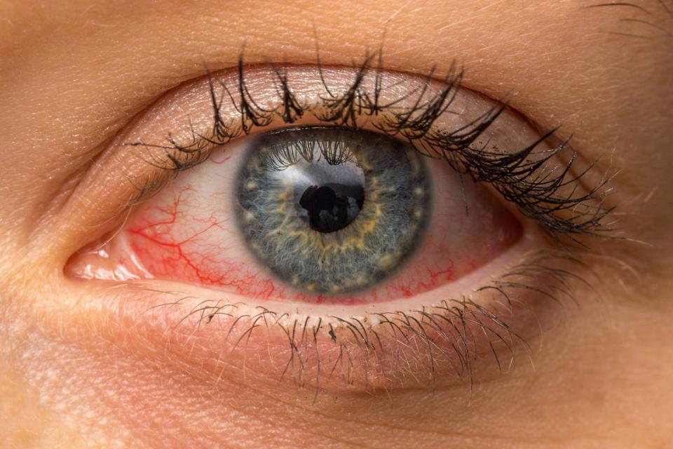 Επιπεφυκίτιδα : Η πάθηση των ματιών 