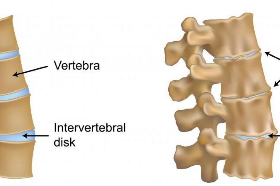 Οστεόφυτα : Η πάθηση της σπονδυλικής στήλης και των άκρων